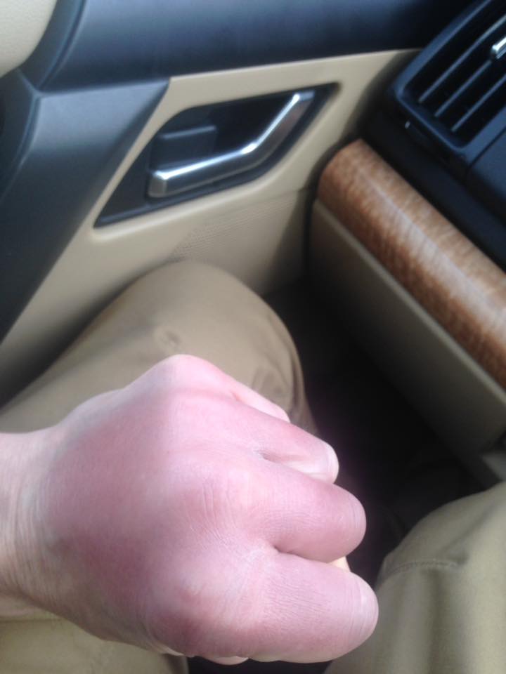Boxer's hands swollen after 12 grueling rounds to with a World Title Fight against Sandy Robb