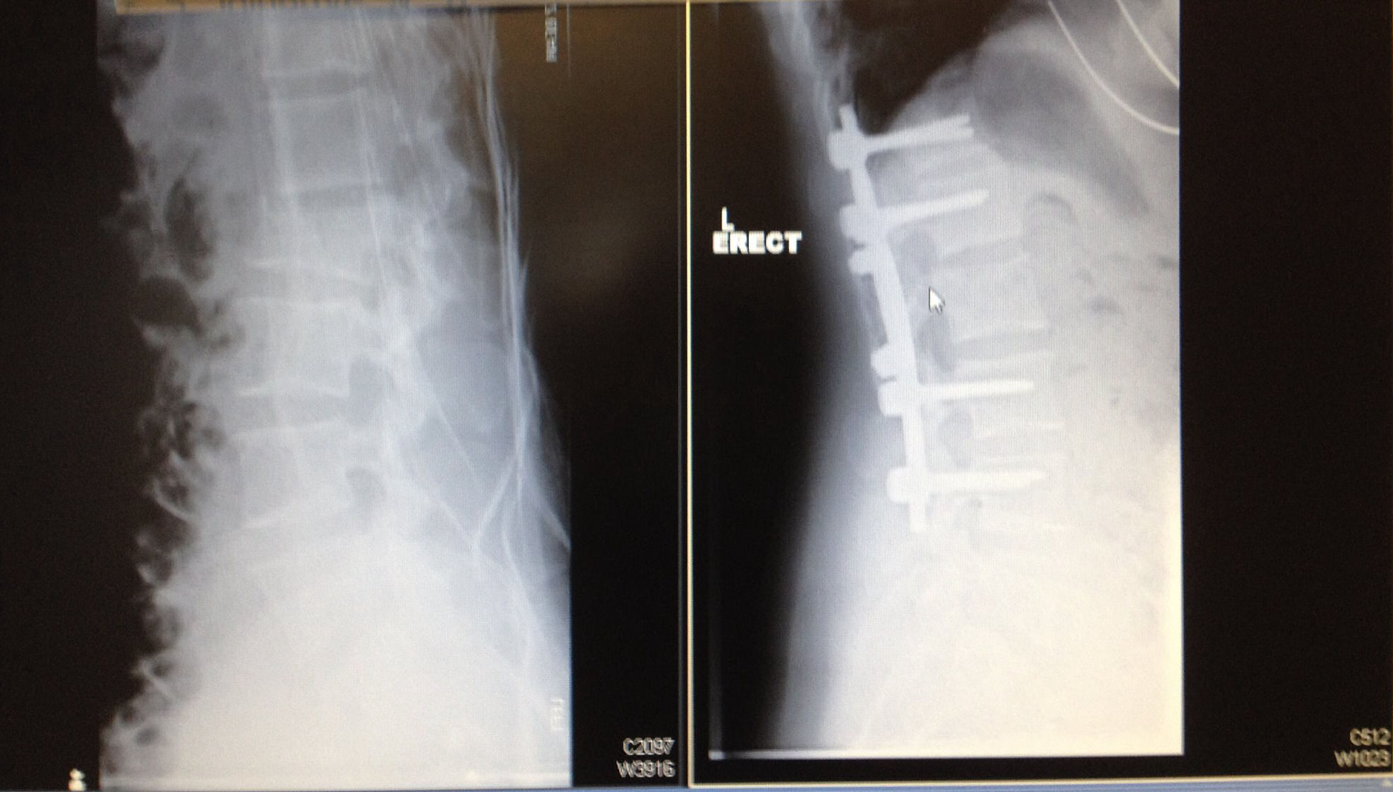 sharon fractured spine xray ibt
