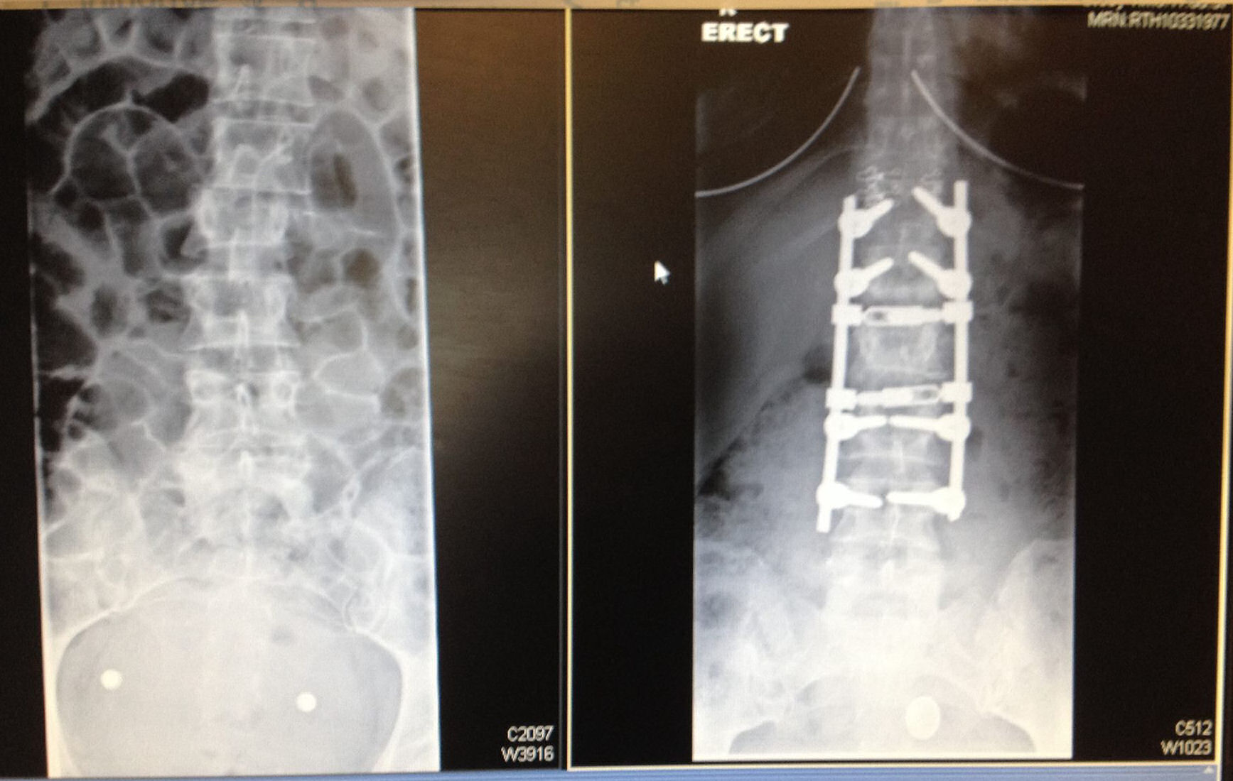 sharon fractured spine xray ibt 1