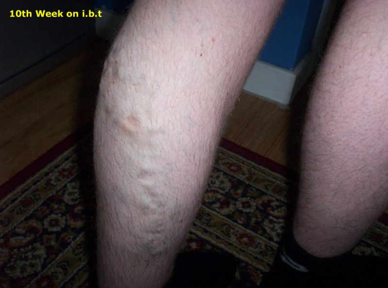 Male 34 varicose veins after 10 weeks of Inclined Therapy